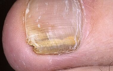Manifestations de champignons sur le pouce de la jambe