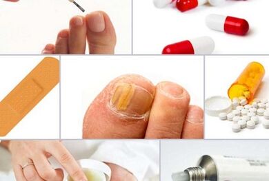 Comment traiter les champignons sur les ongles