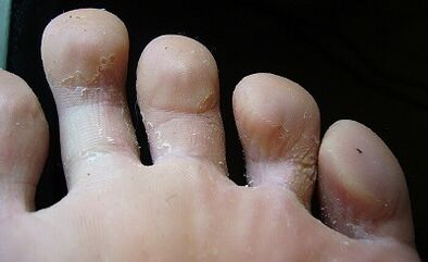 Ce que regarde un champignon sur les jambes et comment le traiter