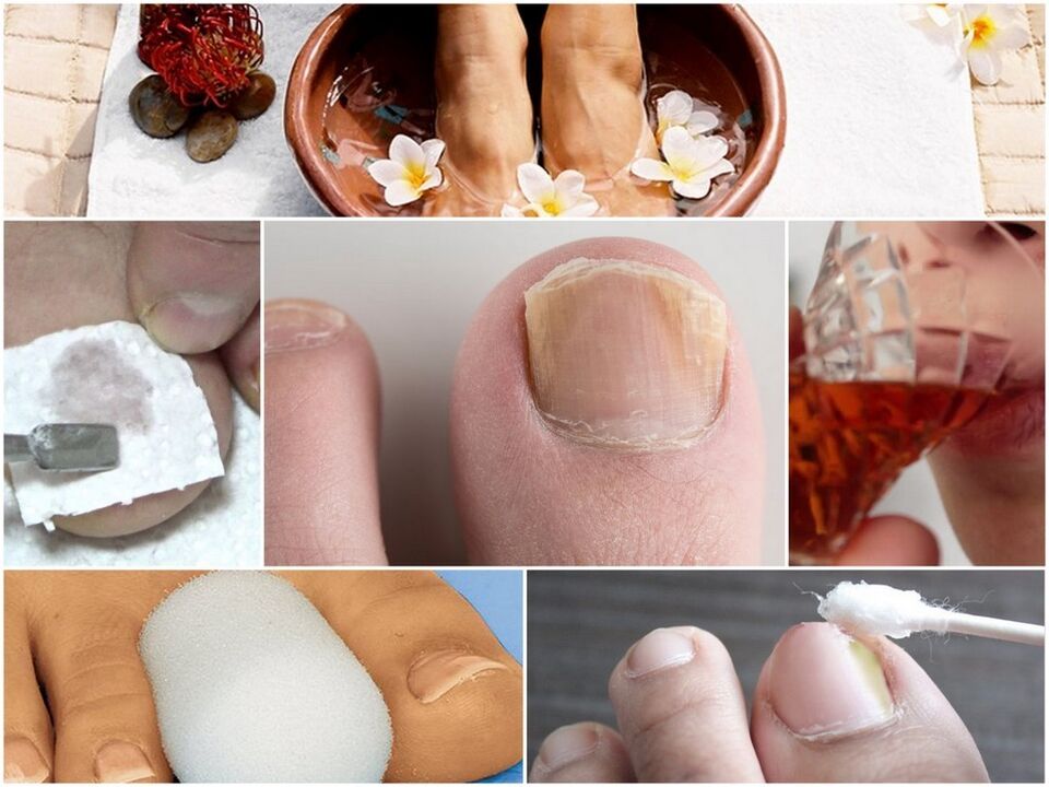 Traitement des champignons à ongles