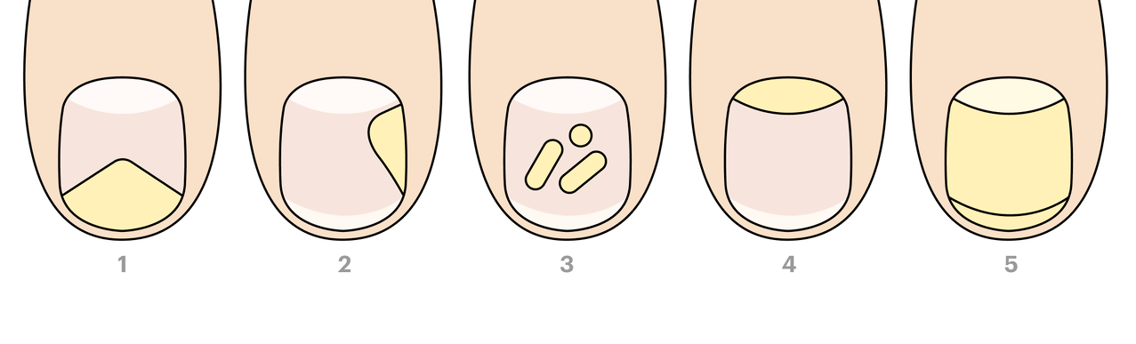 types de champignons des ongles des pieds